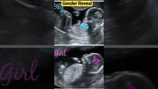 Findout Your Baby’s Gender At the Ultrasound Scan👶🏻Baby Gender Reveal #shorts#short#trending#baby