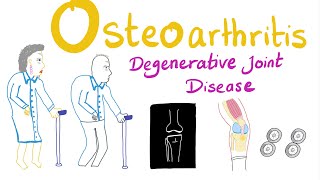 Osteoarthritis (OA) Part 1: Introduction