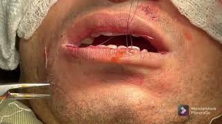 Lip Reduction | Lip shaping | Lip thinning | ঠোঁট চিকন করার সার্জারি | Dr Iqbal Ahmed