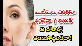 Effective Home Remedy To Get Rid Of Pimples Quickly! Home Remedy - మొటిమ‌లు ఎంత‌కూ త‌గ్గ‌ట్లేదా? అ