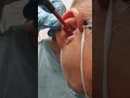 Earwax removal!