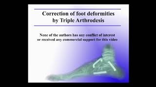 Correction of foot deformities with Triple arthrodesis