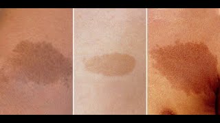 Black patches/Pigmentation/கருவங்கு/Siddha medicine/Dr.R.Bharathi Suresh