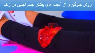 چی گونه گی ثابت سازی اجسام بزرگ داخل زخم ها