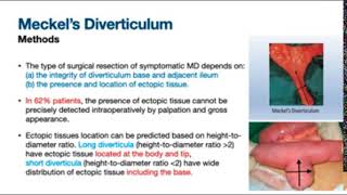 Meckels Diverticulum: Wedge Excision vs Segmental Resection Anastomosis