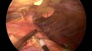 Subxiphoid uniportal VATS extended thymectomy