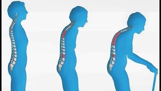 Osteoporoz ( sümük əriməsi) nədir?