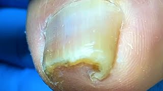 The Amazing Curl Of The Ingrown Nails! Trim It Carefully【Xue Yidao】