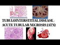 ACUTE TUBULAR NECROSIS || TUBULOINTERSTITIAL DISEASE PART 01|| IMAGES