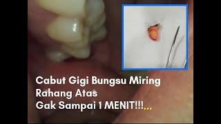 CABUT GIGI BUNGSU ATAS MIRING KURANG DARI 1 MENIT!!!