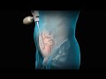 Total Extraperitoneal (TEP) Laparoscopic Inguinal Hernia Repair | Nucleus Health