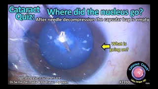 CataractCoach™ 2390: Cataract Quiz: Where did the nucleus go?