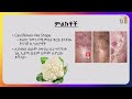 ethiopia የጭን ኪንታሮት ምልክቶች እና መፍትሄዎች wart causes and solutions