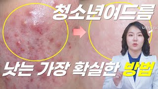 청소년여드름! 피부 좋아지고 싶은가요? 사춘기여드름, 10대 청소년여드름 없애는 법 알려드릴게요