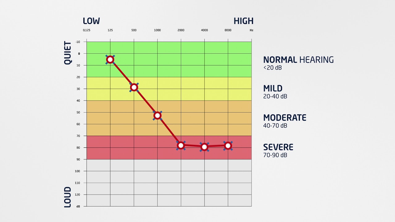 Hear.com - How To Read An Audiogram - YouTube