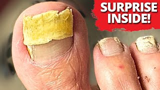 WHAT'S HIDING UNDERNEATH THIS NAIL??! (Must Watch)