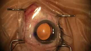 Cataract Surgery by Derek Huang, MD