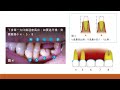 醫藥人 楊幽幽 假牙的種類和設計 牙橋 113 editor in chief online journal of dentistry u0026 oral health