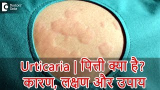 Urticaria : पित्ती क्या है? जाने इसके कारण, लक्षण और उपाय - डॉ. रसया दीक्षित