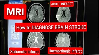 How to Diagnose Acute Infarct, Subacute Infarct, Acute Infarct - Hemorrhagic Transformation on MRI.