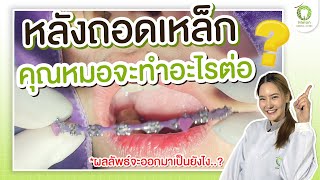 ถอดเครื่องมือ #จัดฟัน ไปเเล้ว คุณหมอจะทำอะไรต่อ? ผลลัพธ์จะเป็นยังไง? | Melon dental clinic