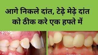 आगे निकले दांत, टेढ़े मेढे दांत को ठीक करें एक हफ्ते में//smile treatment // gap in teeth treatment