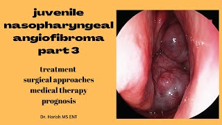 Juvenile Nasopharyngeal Angiofibroma part 3/3 | treatment, surgical approaches | MBBS - ENT