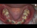 hyrax expander step by step in orthodontics try in cementation and activation by dr amr asker