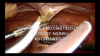 Endometrioza z naciekiem na nerw kulszowy