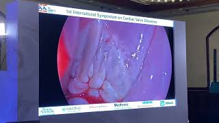 1st International Symposium on Cardiac Valve Diseases: Transcatheter, Endoscopic \u0026 Hybrid Techniques