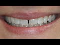 Houston Cosmetic Dentist...Dislike your Gap between your front teeth? 1 Hour Cosmetic Bonding:)