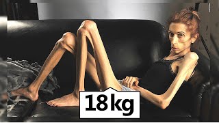 La triste vie de la femme la plus maigre du monde