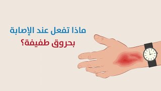 ماذا تفعل عند الإصابة بحروق طفيفة؟