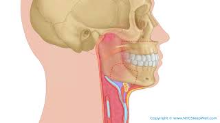 Jaw Surgery (Orthognathic Surgery) for Sleep Apnea - NYC SleepWell