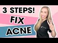 3 Steps To Fix Your Acne WITHOUT A Prescription | Skincare Made Simple by The Budget Dermatologist