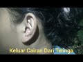 Keluar Cairan Putih Dari Telinga (Dolean) Mungkin Karena Terlalu Lama Batuk