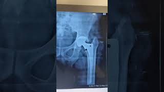 Loose stem in Partial Hip replacement !! #surgeryday #surgical_ot