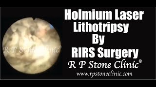 Holmium Laser Lithotripsy by RIRS Surgery