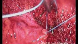 laparoscopic paravaginal repair; cystocele; lateral repair