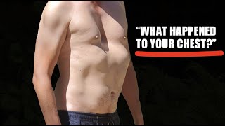 Rude Things People Say When You have Pectus Excavatum (How to Respond!)
