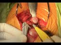 Cementless total hip replacement in a dog - Surgical Procedure