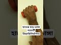 হাতের হাড় ভাঙ্গা পরবর্তী রিহ্যাবিলিটেশন। handfracture rehabilitation regainrangeofmotion shorts