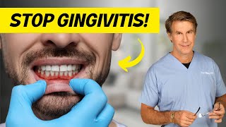 Gingivitis: Symptoms, Causes, and How to Stop It