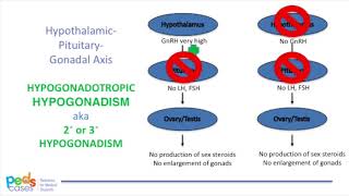 Puberty and Pubertal Disorders – Part 3: Delayed Puberty