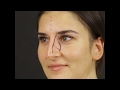 90° TAS Video | 5 Months After Closed Atraumatic Rhinoplasty