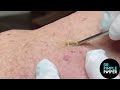 8 minutes of satisfying pops with dr sandra lee dr pimple popper