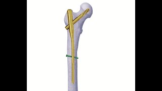 Proximal femoral nailing technique. A video was produced from Touch Surgery™ apps.