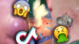 Pimple Blackheads Cysts Popping Videos TikTok Compilation Part 12
