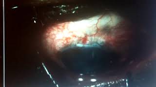 Slit Lamp Procedures: Bleb Revision in Patient with Hypotony