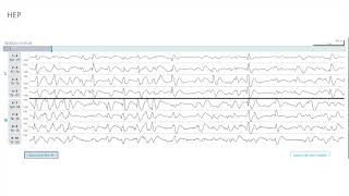 EEG Atlas B3: Understand EEG Through Examples With The Ceribell Rapid Response System